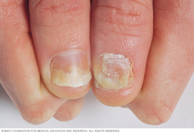 受银屑病影响的拇指指甲
