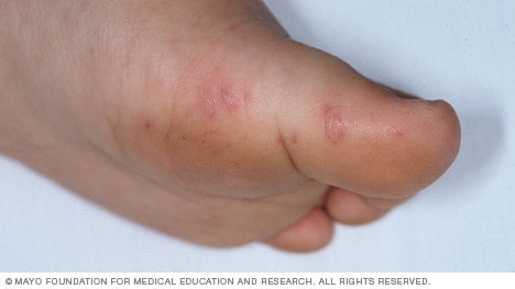 Hand Foot And Mouth Disease Symptoms And Causes Mayo Clinic