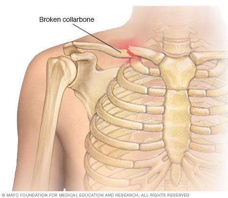signs of a broken collarbone