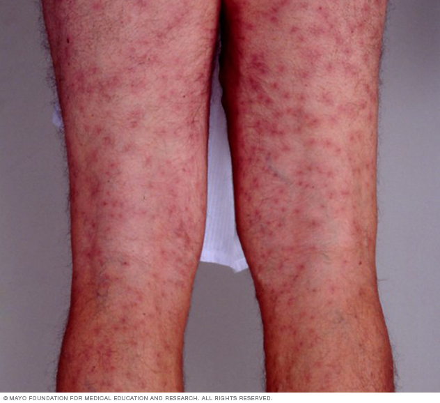 pictures of swimmers itch