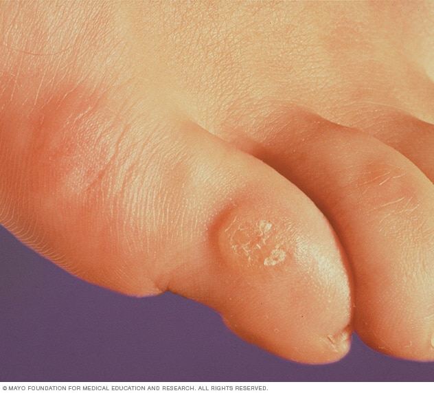 Corns and calluses - Symptoms and causes - Mayo Clinic