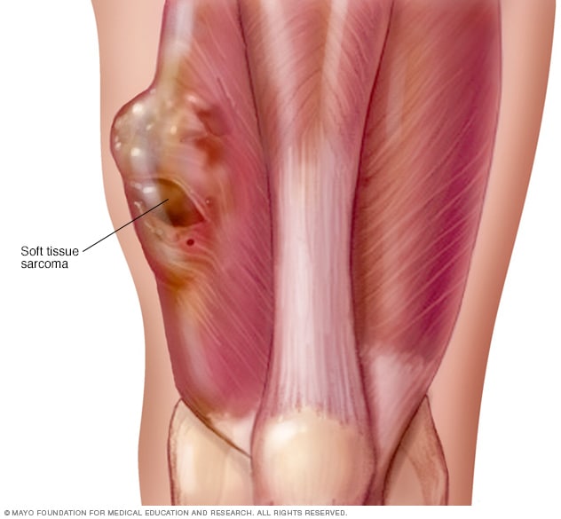 Soft tissue sarcoma - Symptoms and causes - Mayo Clinic