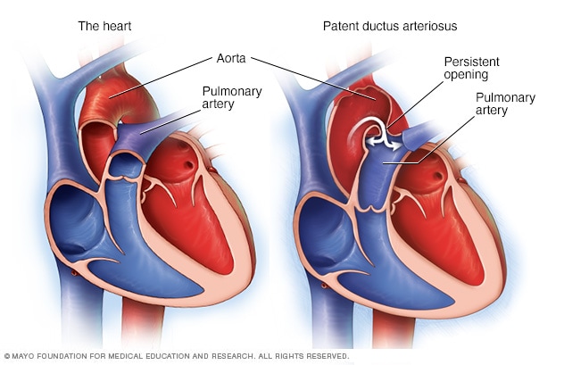 Illustration of a patent ductus arteriosus