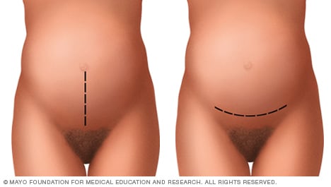 cesarean section incision types