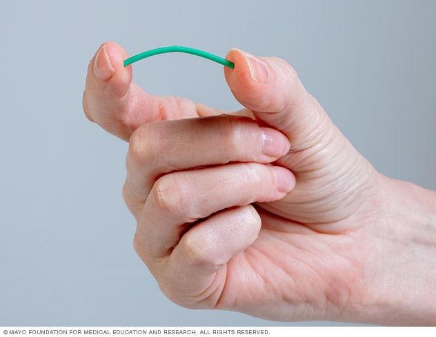 Contraceptive implant - Mayo Clinic