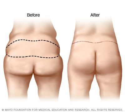 Buttock Enhancement