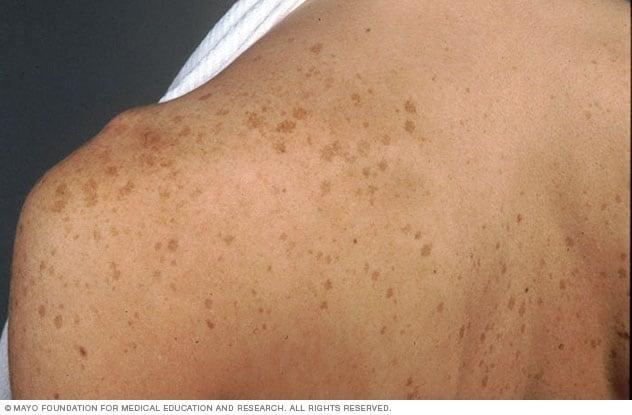 Identifying 21 Common Red Spots on Skin - Universal Dermatology