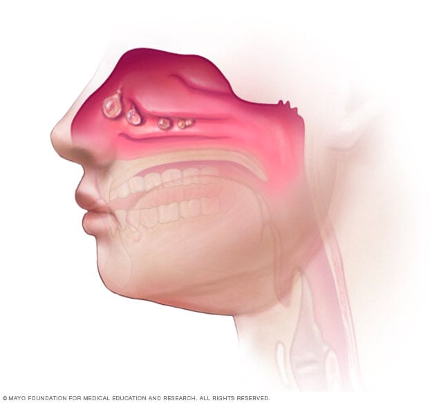 Pólipos nasales en la nariz y los senos paranasales