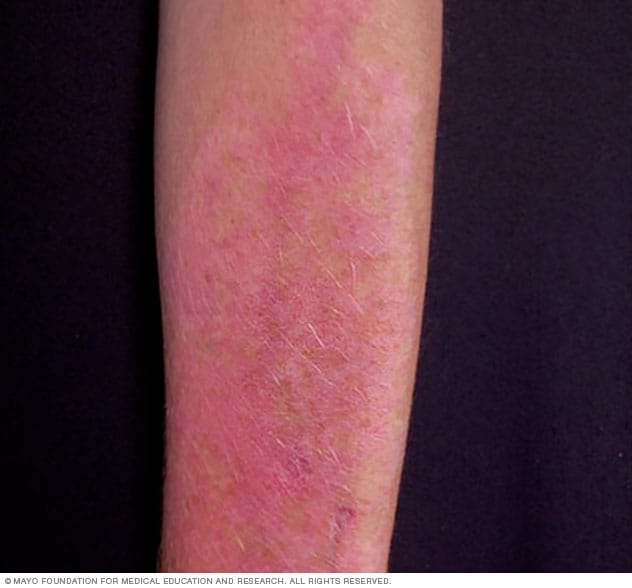 Polymorphous light eruption - and causes Mayo Clinic