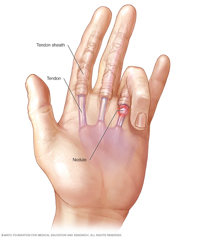 Fasciculations, Hand Atrophy & Curling Pinky Finger