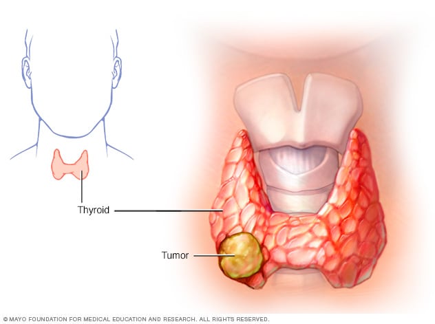 Cáncer de tiroides - Síntomas y causas - Mayo Clinic
