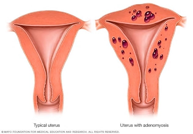 Adenomyosis Symptoms And Causes Mayo Clinic