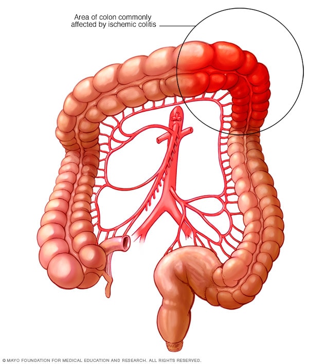 Ischemic colitis - Symptoms and causes - Mayo Clinic diagram of colitis 