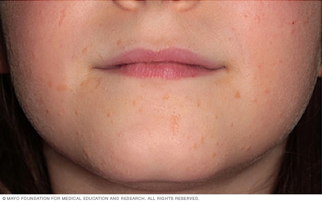 10+ Hpv Tiny Bumps On Lips Pictures
