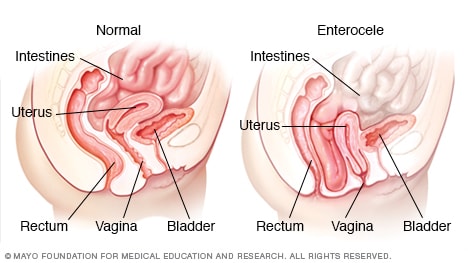 Bladder Prolapse: Causes, Symptoms, Treatment, and Prevention