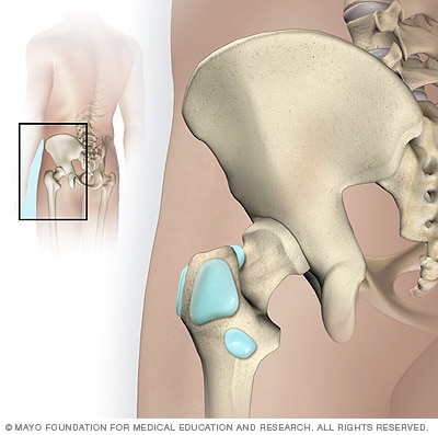 https://www.mayoclinic.org/-/media/kcms/gbs/patient-consumer/images/2013/08/26/10/30/ds00032_im01997_mcdc7_hip_bursitisthu_jpg.png