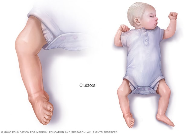 Clubfoot - Symptoms and causes - Mayo Clinic