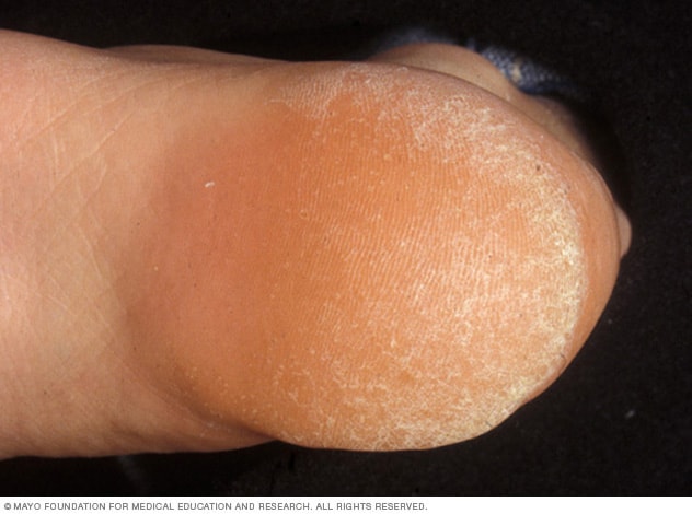 calluses on ball of foot