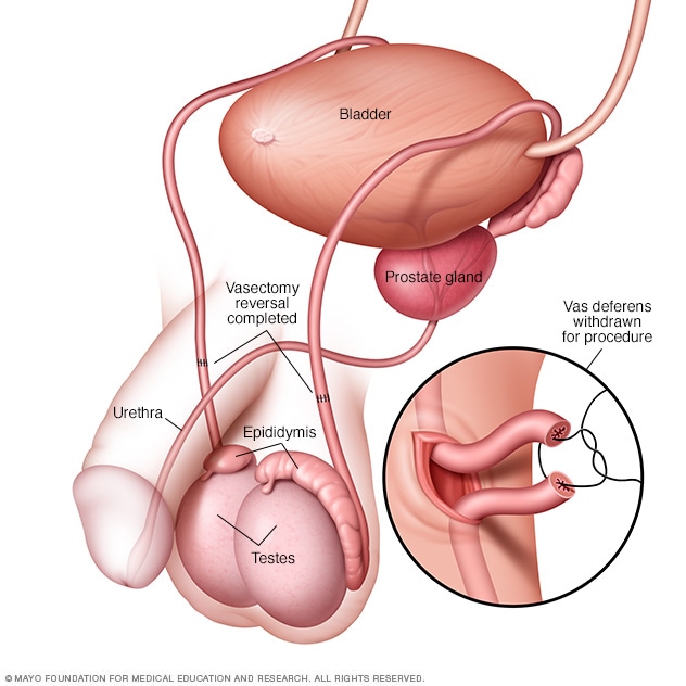 Vasectomy reversal