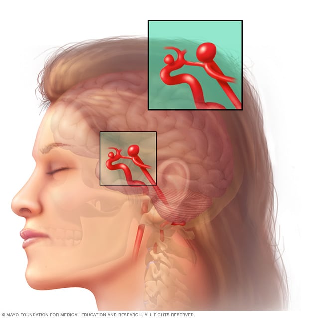 Brain Aneurysm Symptoms And Causes Mayo Clinic