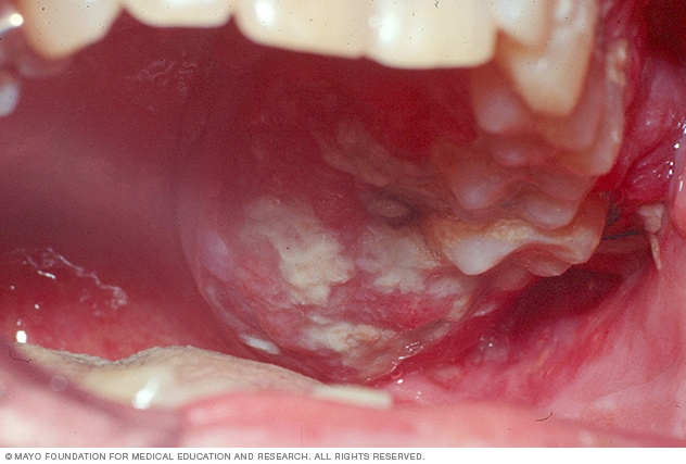 throat cancer from tobacco