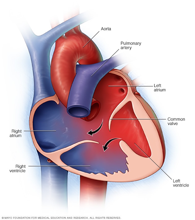 atrioventricular-canal-defect-mayo-clinic