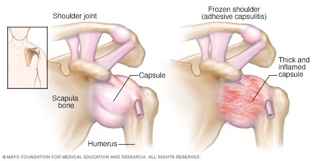 Shoulder Pain Causes & Conditions