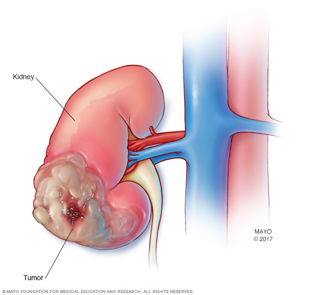 cancer de rinon con metastasis