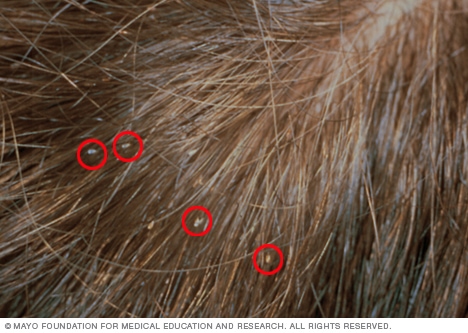 Lice Symptoms  Do You Have Lice Heres How to Find Out