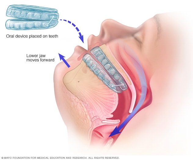 https://www.mayoclinic.org/-/media/kcms/gbs/patient-consumer/images/2013/08/26/10/40/ds00968_im04013_sl7_sleep_apnea_oral_devicethu_jpg.jpg