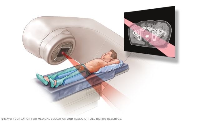 Prostate cancer: A new type of radiation treatment limits risk of