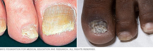 Toenail Fungus - Onychomycosis or tinea unguium - OC Foot and