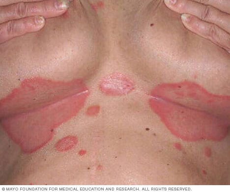 Inverse psoriasis below the breast - Stock Image - C050/9836 - Science  Photo Library