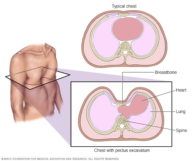 Pectus excavatum - Mayo Clinic a diagram of breastbone 