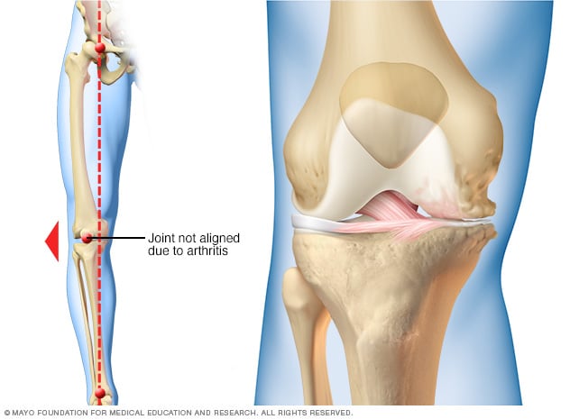 关节炎如何影响一侧膝盖