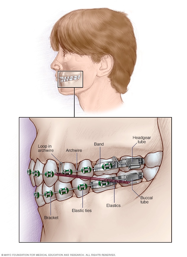 Aparatos de ortodoncia fijos 