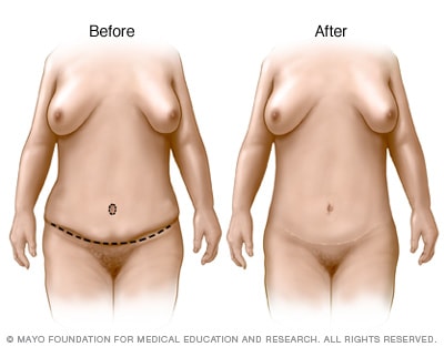 Reducción de abdomen - Mayo Clinic