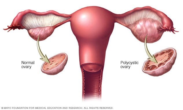 Ovario sano y ovario poliquístico