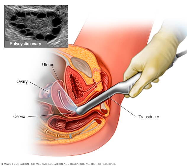 Transvaginal ultrasound Mayo Clinic
