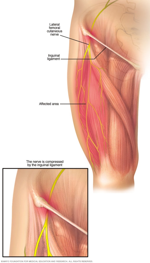 pinched nerve in leg