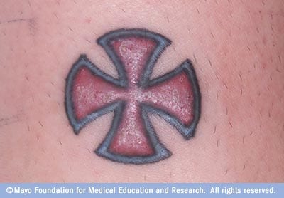 Tattoos, Red Ink, and Sensitivity Reactions