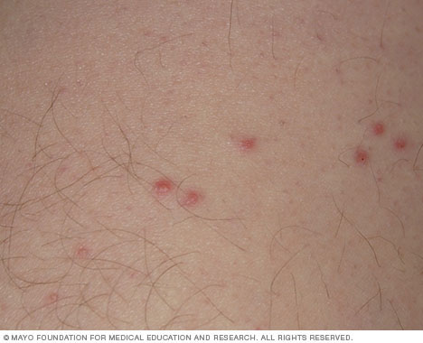 bed bug bites not itchy