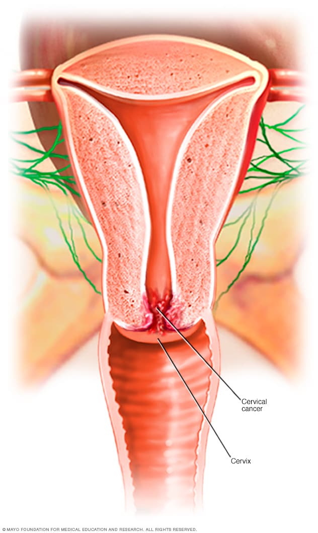 what causes cervical cancer
