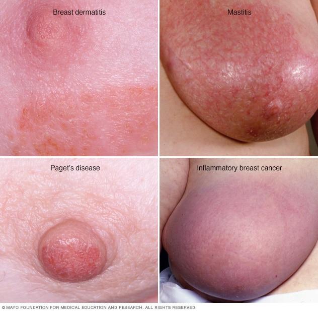 under breast fungal rash