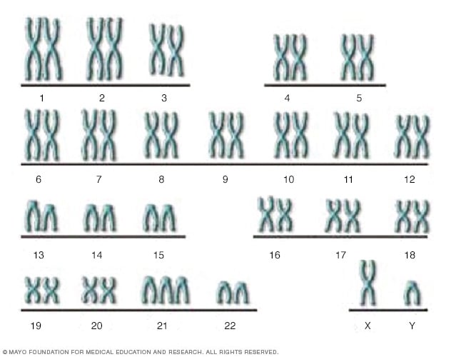 mosaic down syndrome chromosome