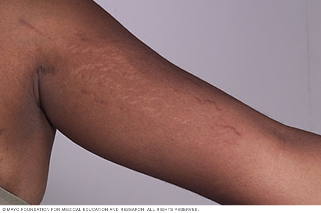 stretch marks on arms