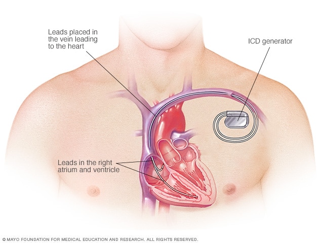 Desfibrilador Cardioversor Implantable Mayo Clinic
