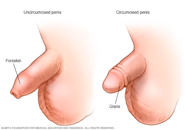 Penis before and after circumcision - Mayo Clinic