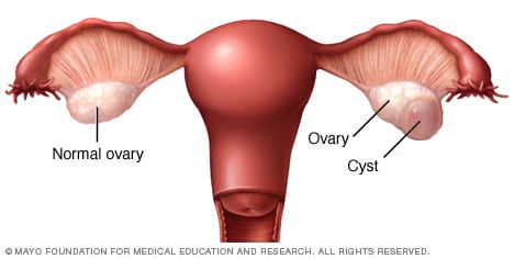 ovarian cyst popping