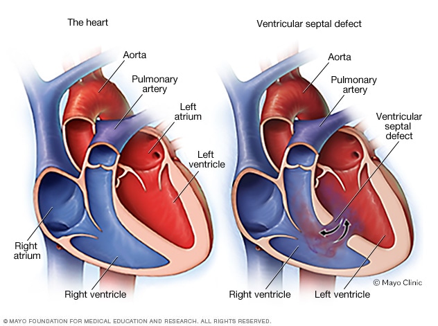 Illustration showing ventricular septal defect